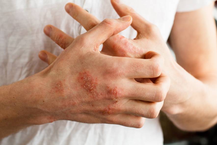 Dermatitis en las manos