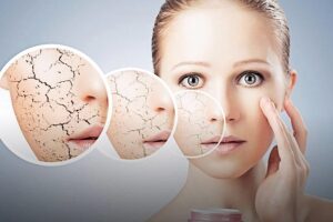 Dermatitis Perioral Qué es y Tratamientos - Gabriel Serrano