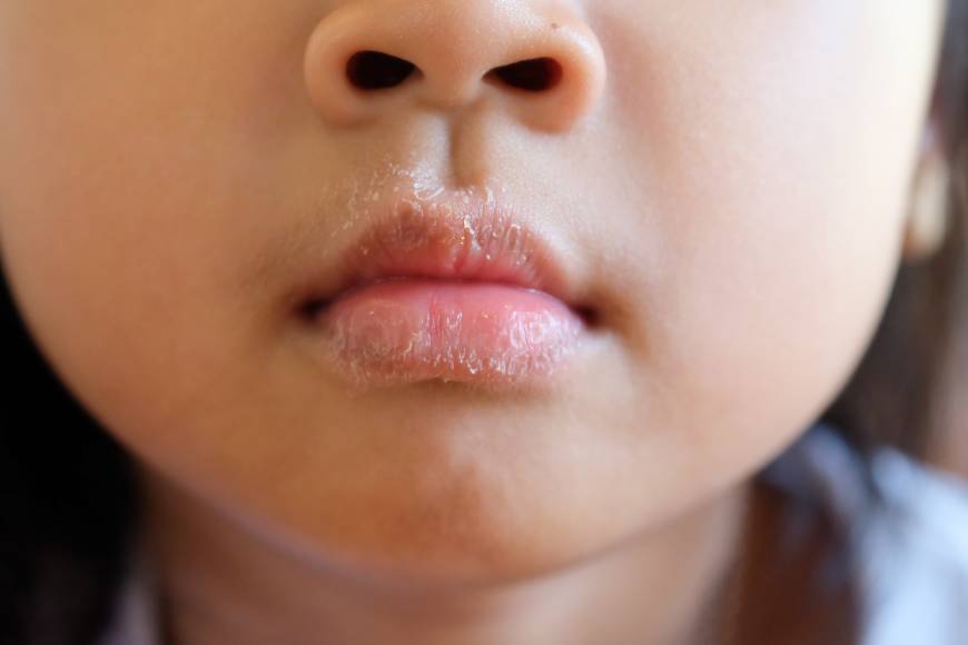 Dermatitis perioral en los niños